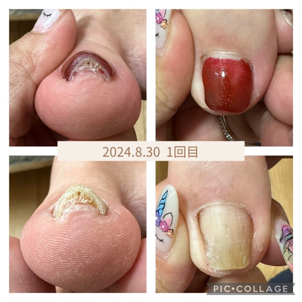 Nail No.2354【巻き爪】