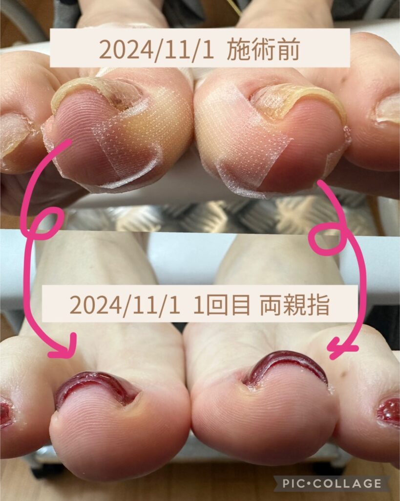 Nail No.2514【巻き爪ケア2024/11/1 1回目①】