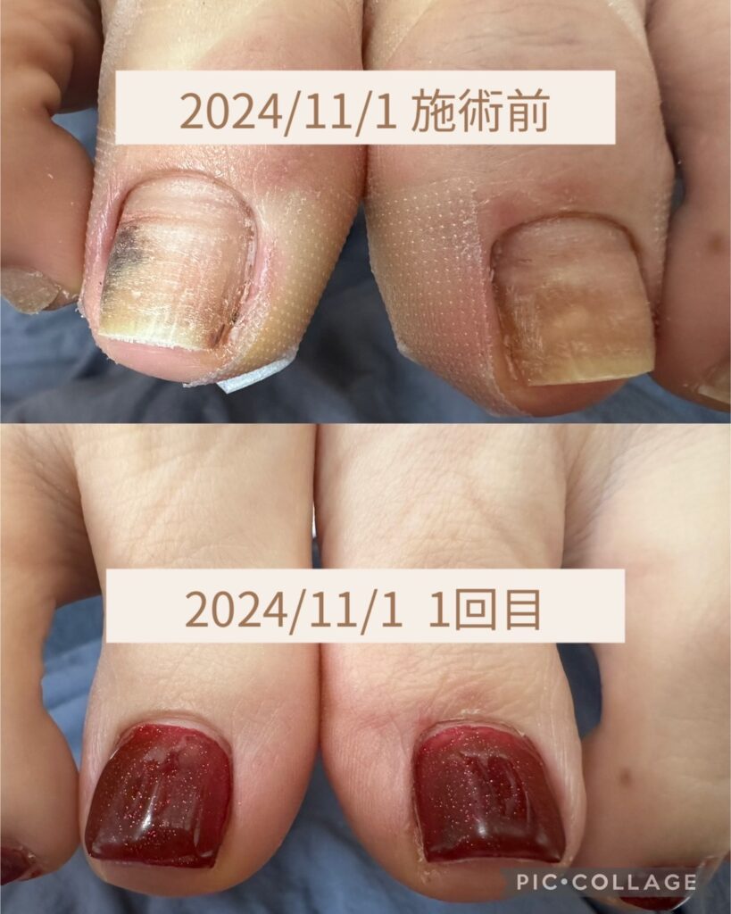 Nail No.2515【巻き爪ケア2024/11/1 1回目②】