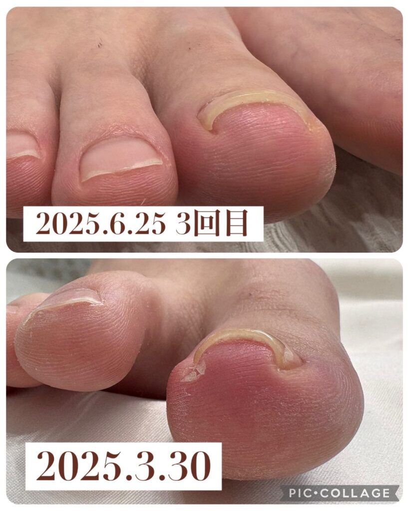 Nail No.3051【巻爪①】