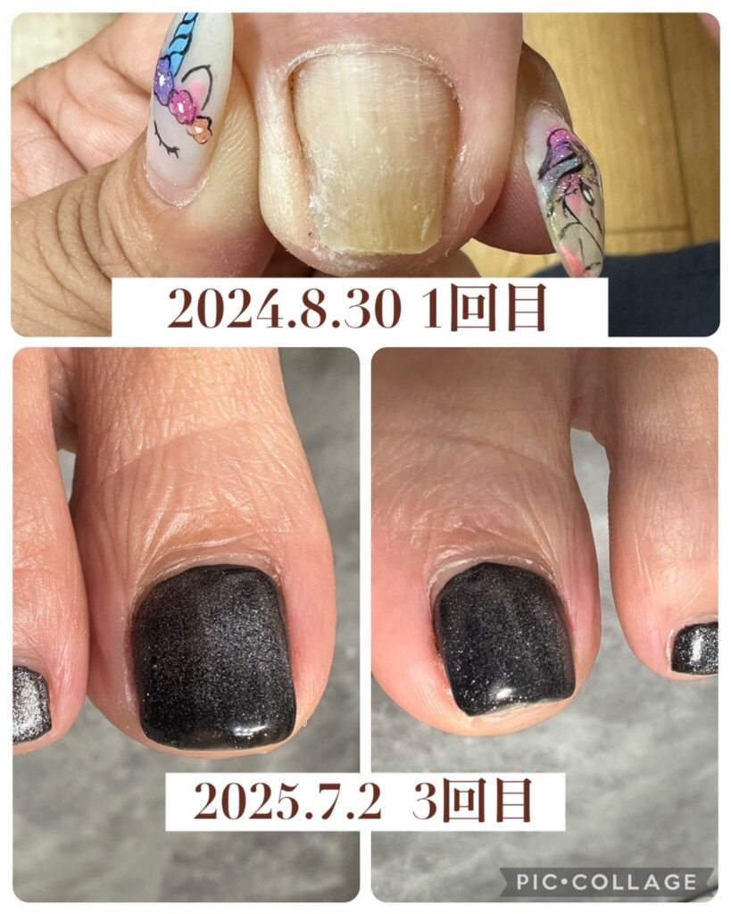 Nail No.3068【巻き爪矯正①】