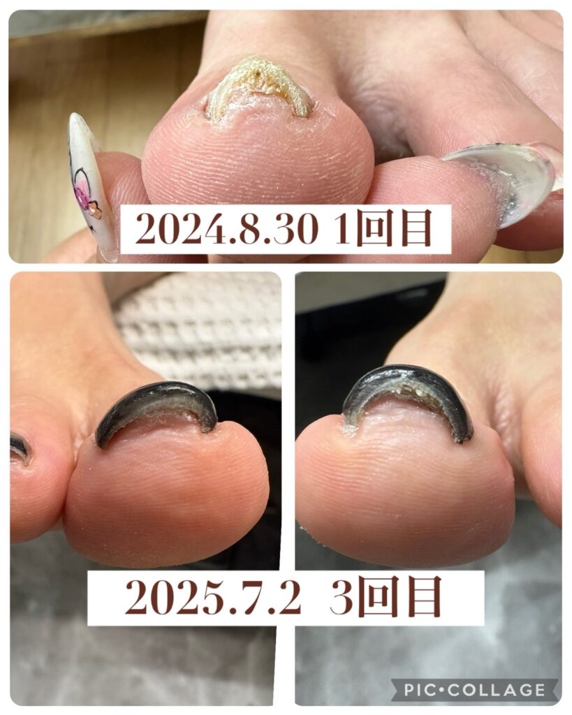 Nail No.3069【巻き爪矯正②】