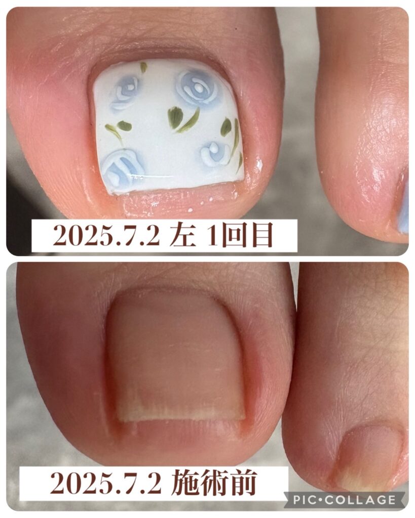 Nail No.3071【巻き爪矯正①】
