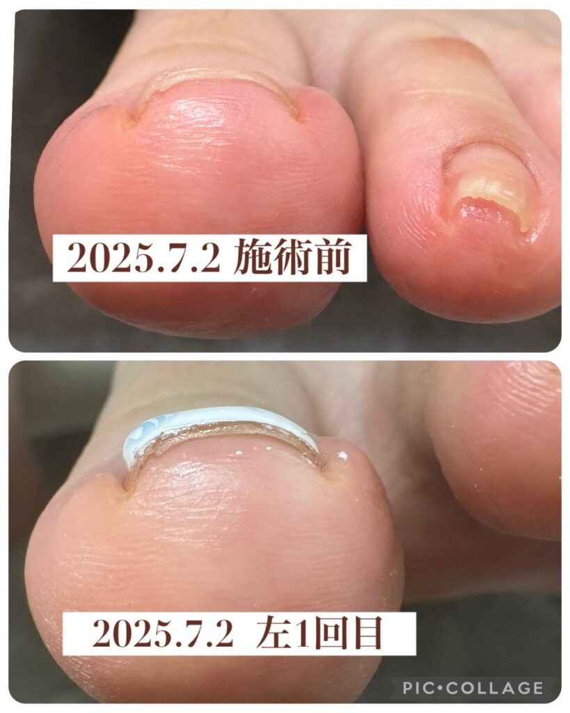 Nail No.3072【巻き爪矯正②】