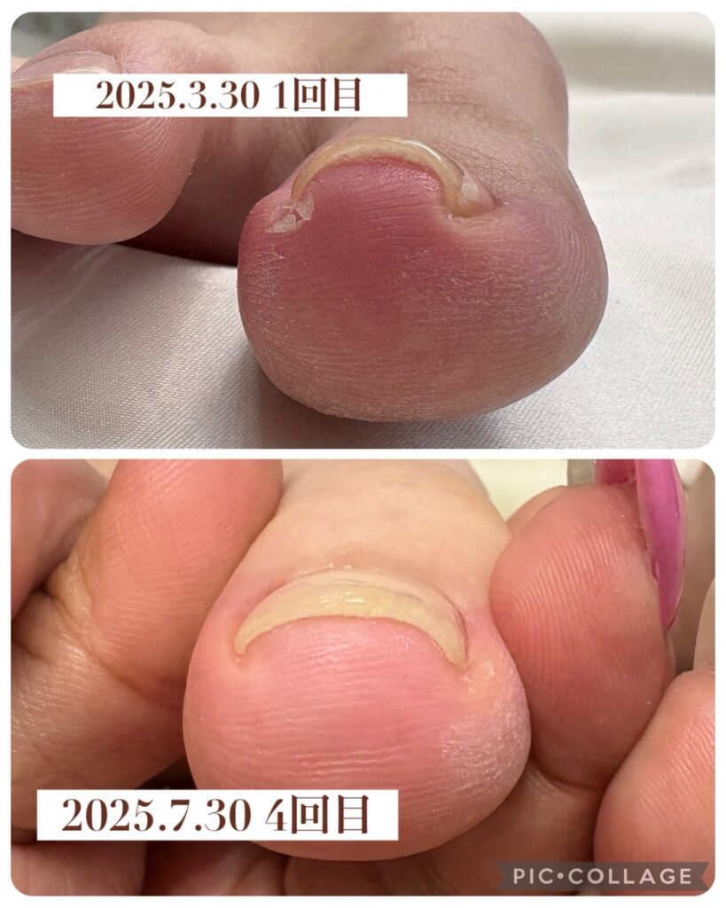 Nail No.3157【巻き爪矯正①】