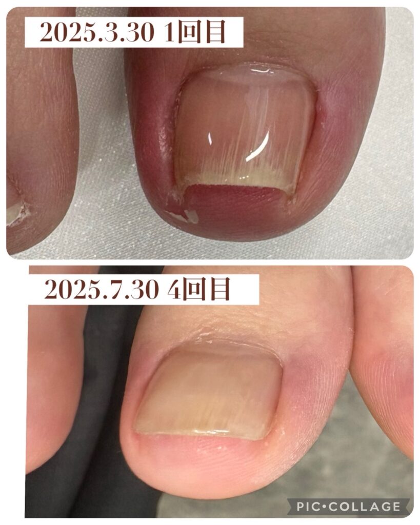 Nail No.3158【巻き爪矯正②】