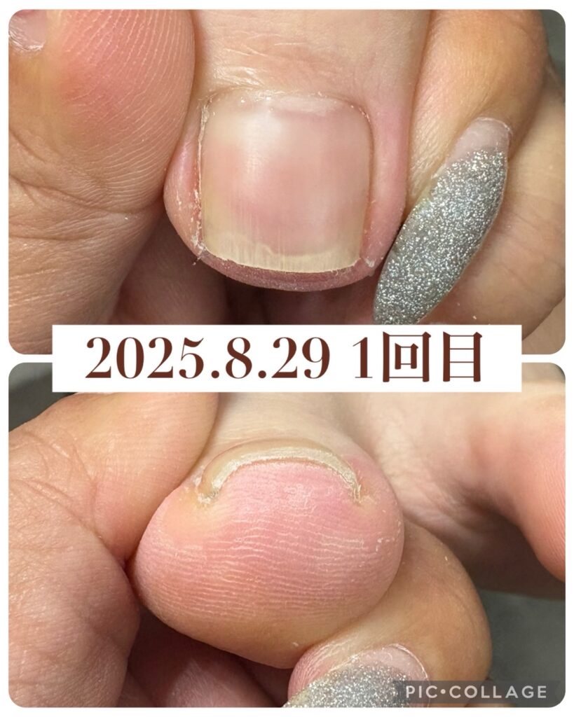 Nail No.3252【巻き爪矯正①】