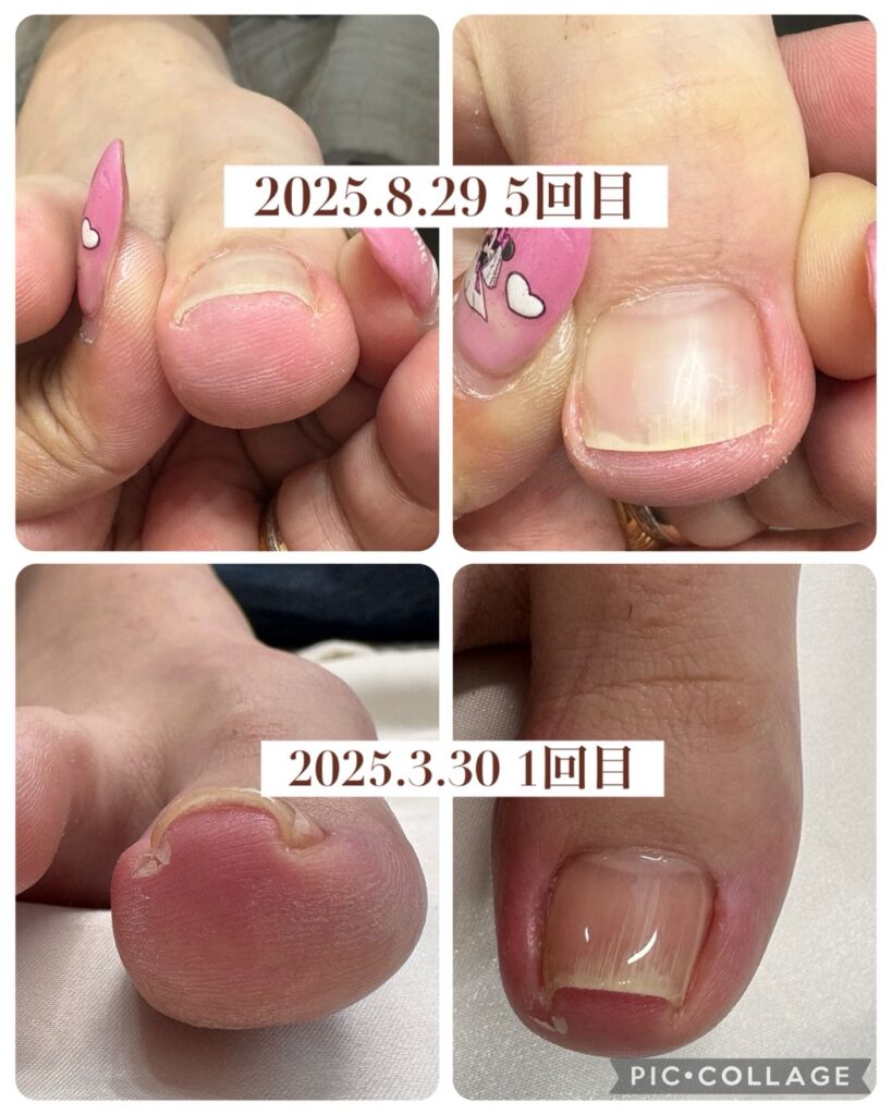 Nail No.3253【巻き爪矯正②】