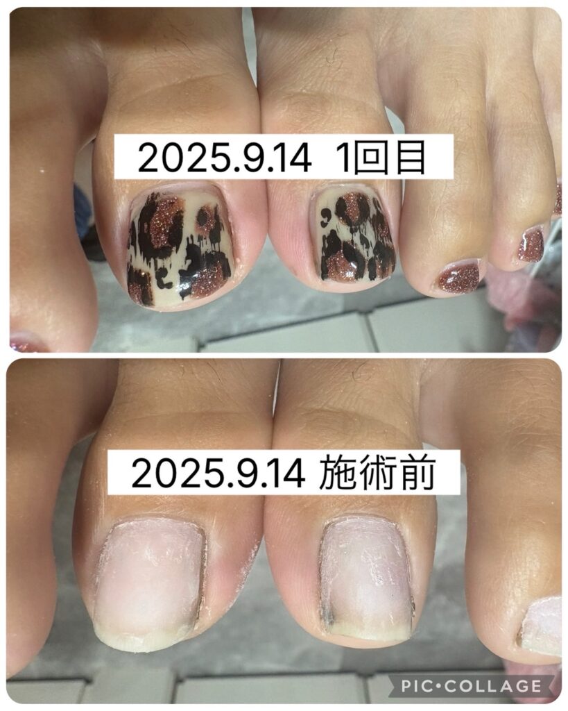 Nail No.3292【巻き爪矯正①】