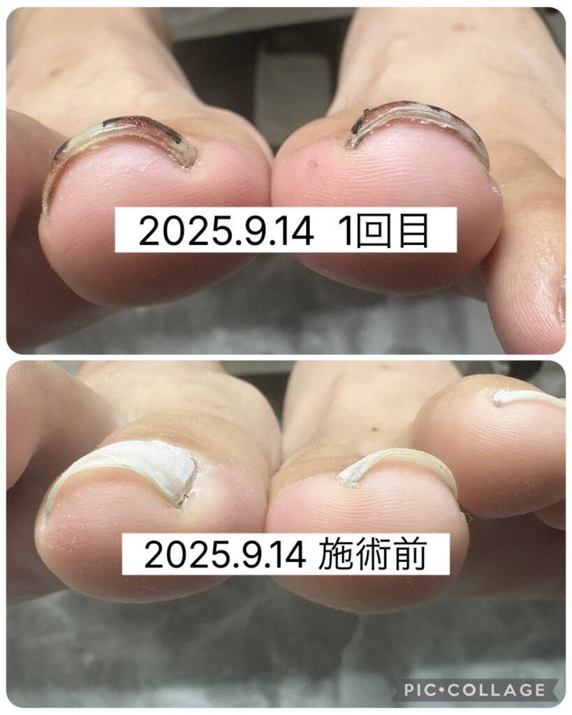 Nail No.3293【巻き爪矯正②】