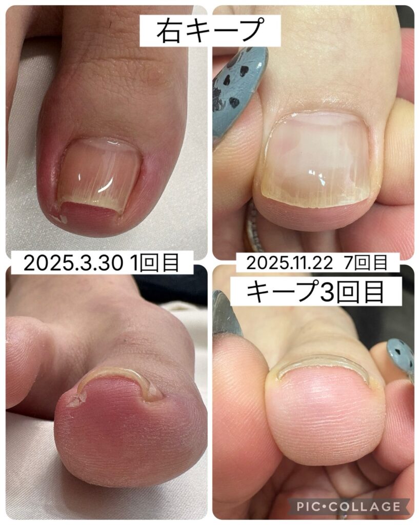 Nail No.3474【巻き爪の経過】