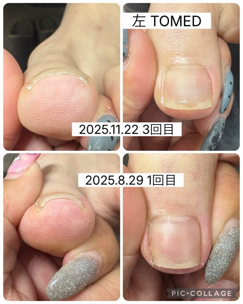 Nail No.3475【自然なカーブへ…巻き爪矯正】