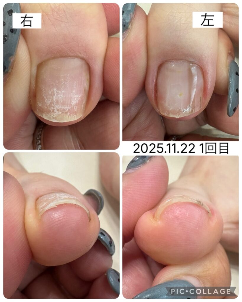 Nail No.3476【巻き爪矯正の様子】