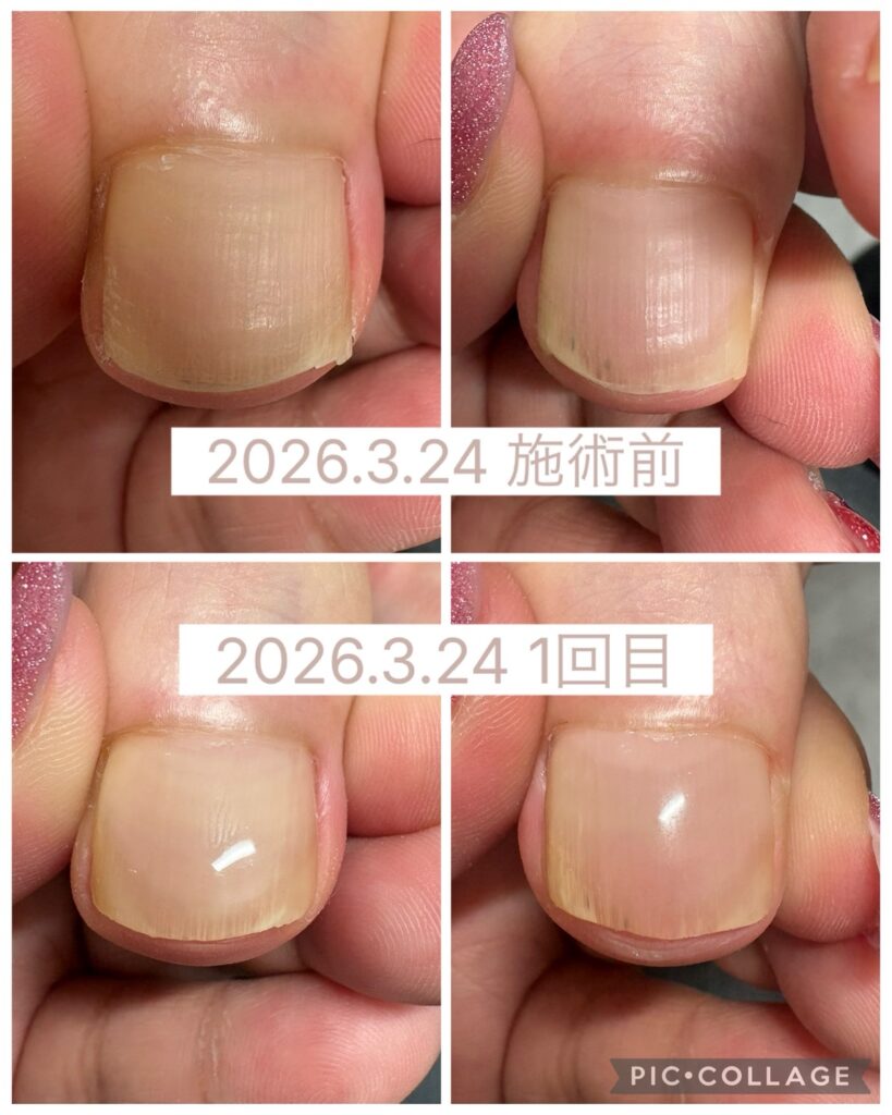 Nail No.3832【巻き爪矯正の経過①】