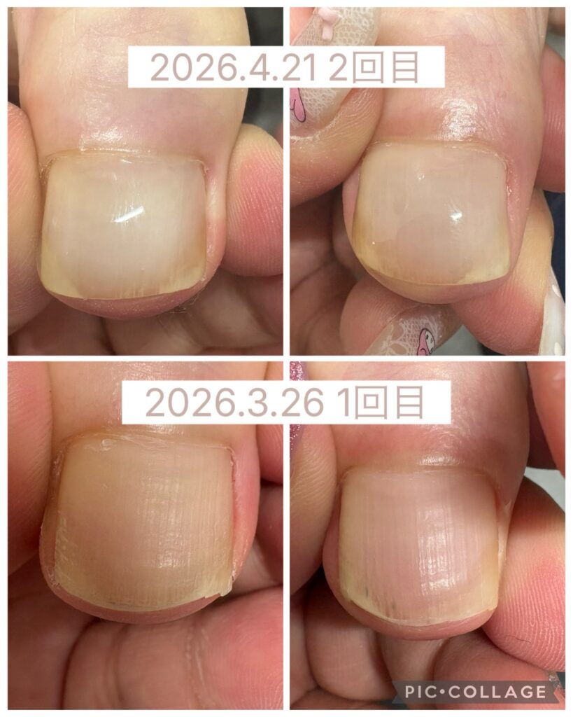 Nail No.3916【巻き爪矯正①】