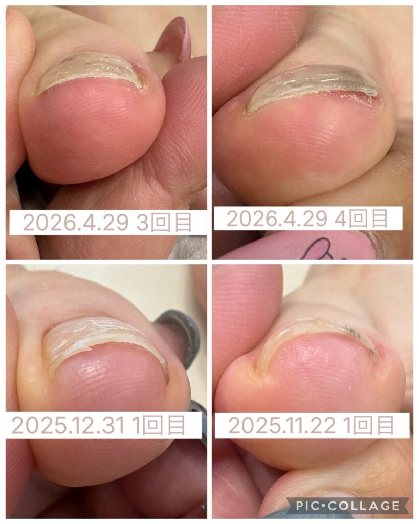 Nail No.3953【巻き爪矯正①】