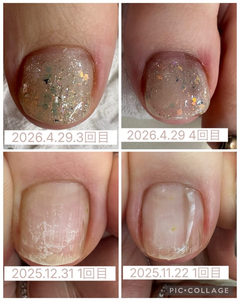 Nail No.3954【巻き爪矯正②】