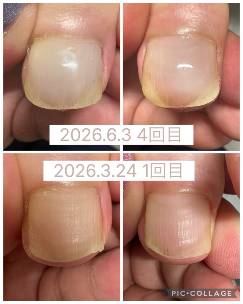 Nail No.4047【巻き爪矯正①】