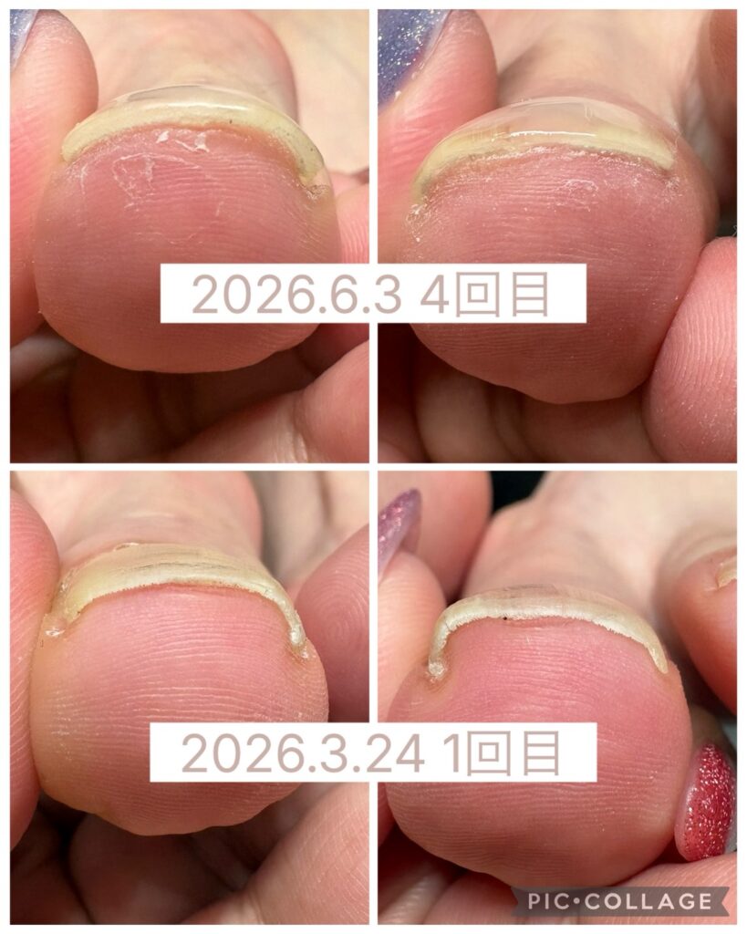 Nail No.4048【巻き爪矯正②】