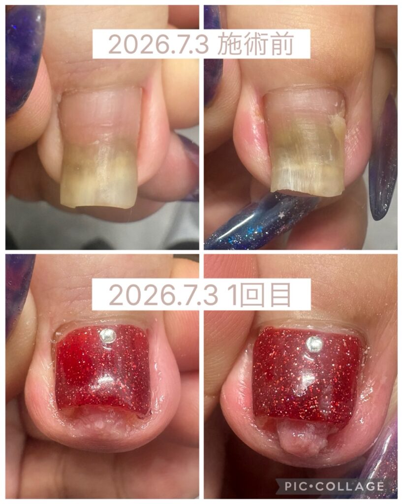 Nail No.4134【巻き爪矯正 1回目①】