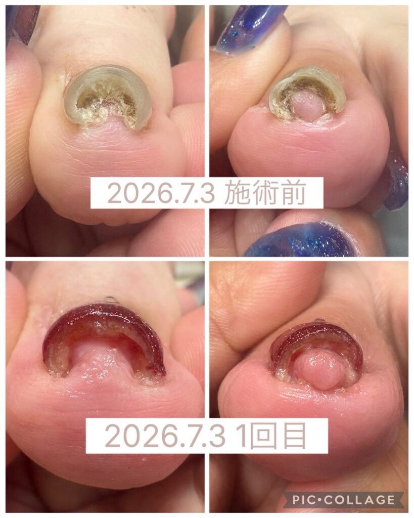 Nail No.4135【巻き爪矯正 1回目②】
