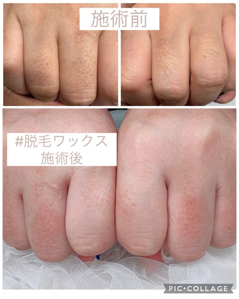 Nail No.4152【脱毛ワックス施術】