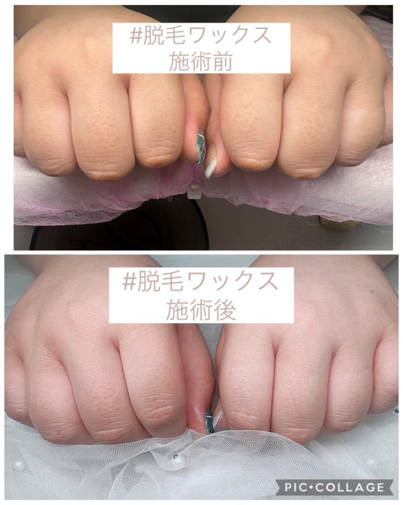 Nail No.4165【脱毛ワックス施術】