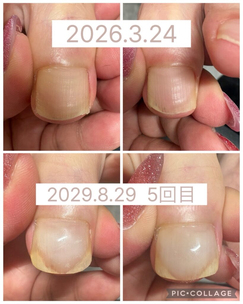 Nail No.4206【巻き爪矯正5回目①】