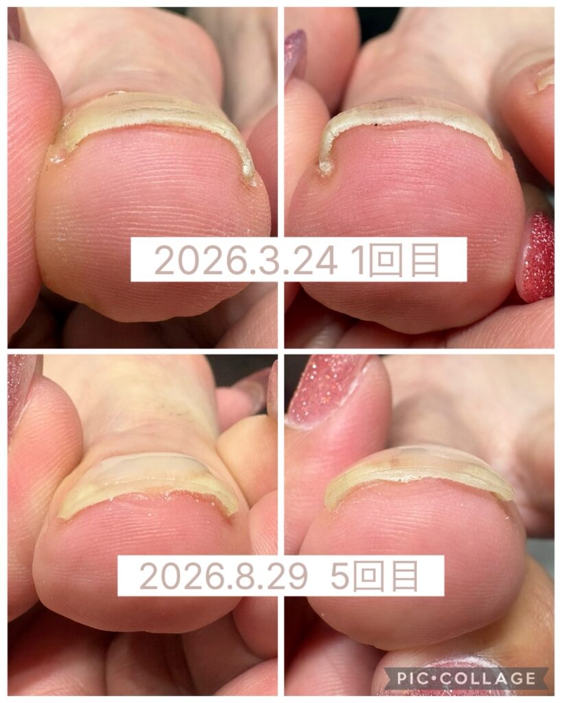 Nail No.4207【巻き爪矯正5回目②】