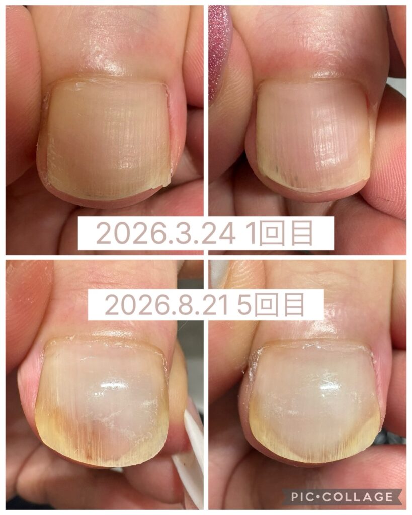 Nail No.4275【巻き爪矯正5回目①】