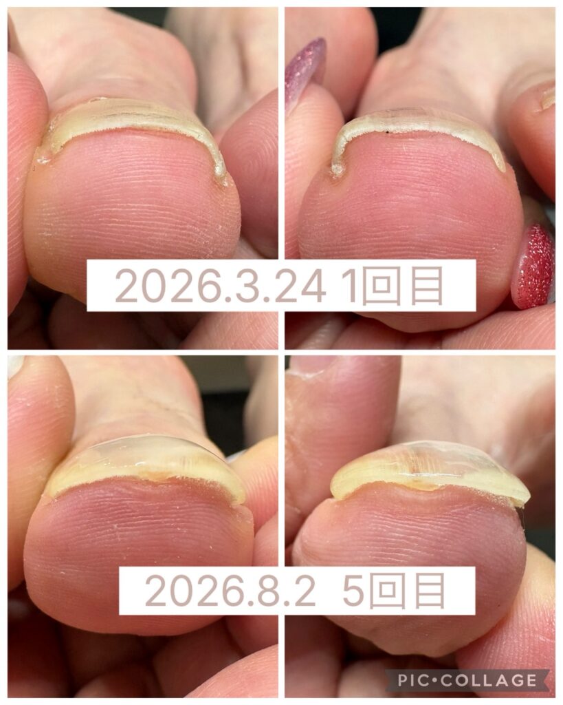 Nail No.4276【巻き爪矯正5回目②】