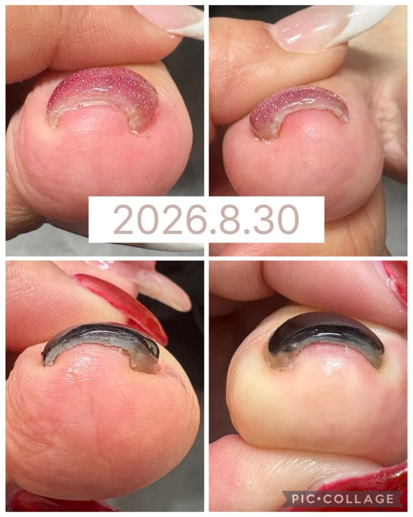 Nail No.4305【巻き爪矯正】